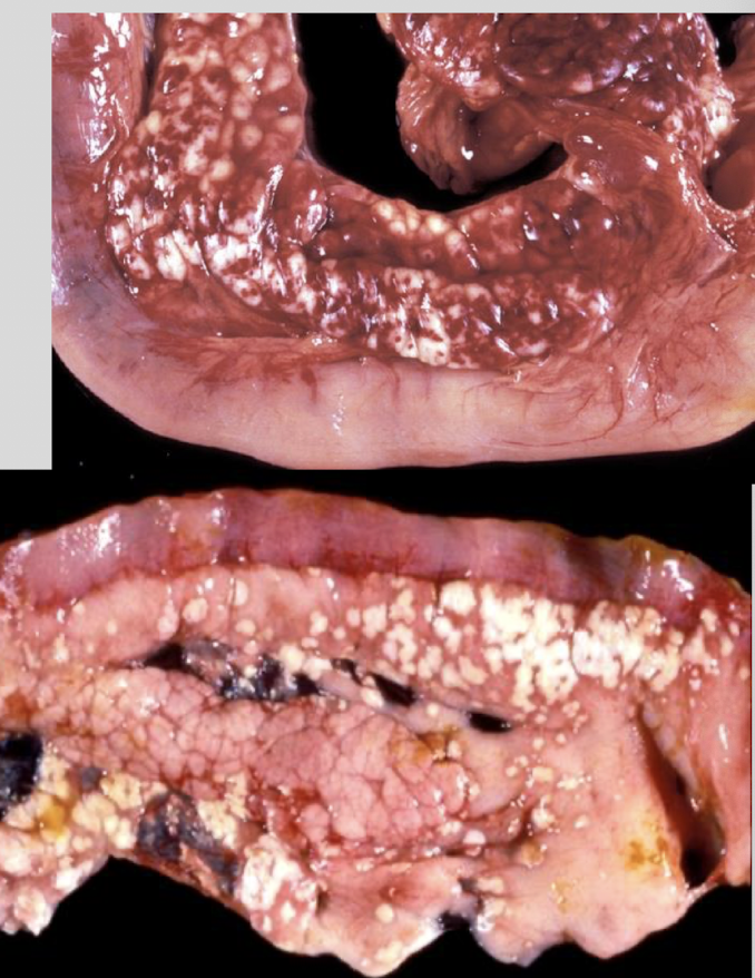 <p>hemorrhagic pancreas w prominent edema &amp; multi-colored areas</p><p>chalky white areas of fat necrosis by lipolytic enzymes (w 2<sup>o</sup> mineralization)</p>