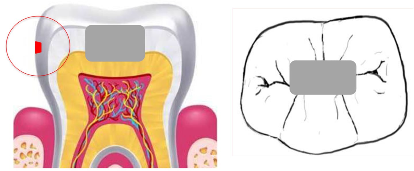 <p>another cavity may appear because did not focus on the entire tooth from the beginning</p>