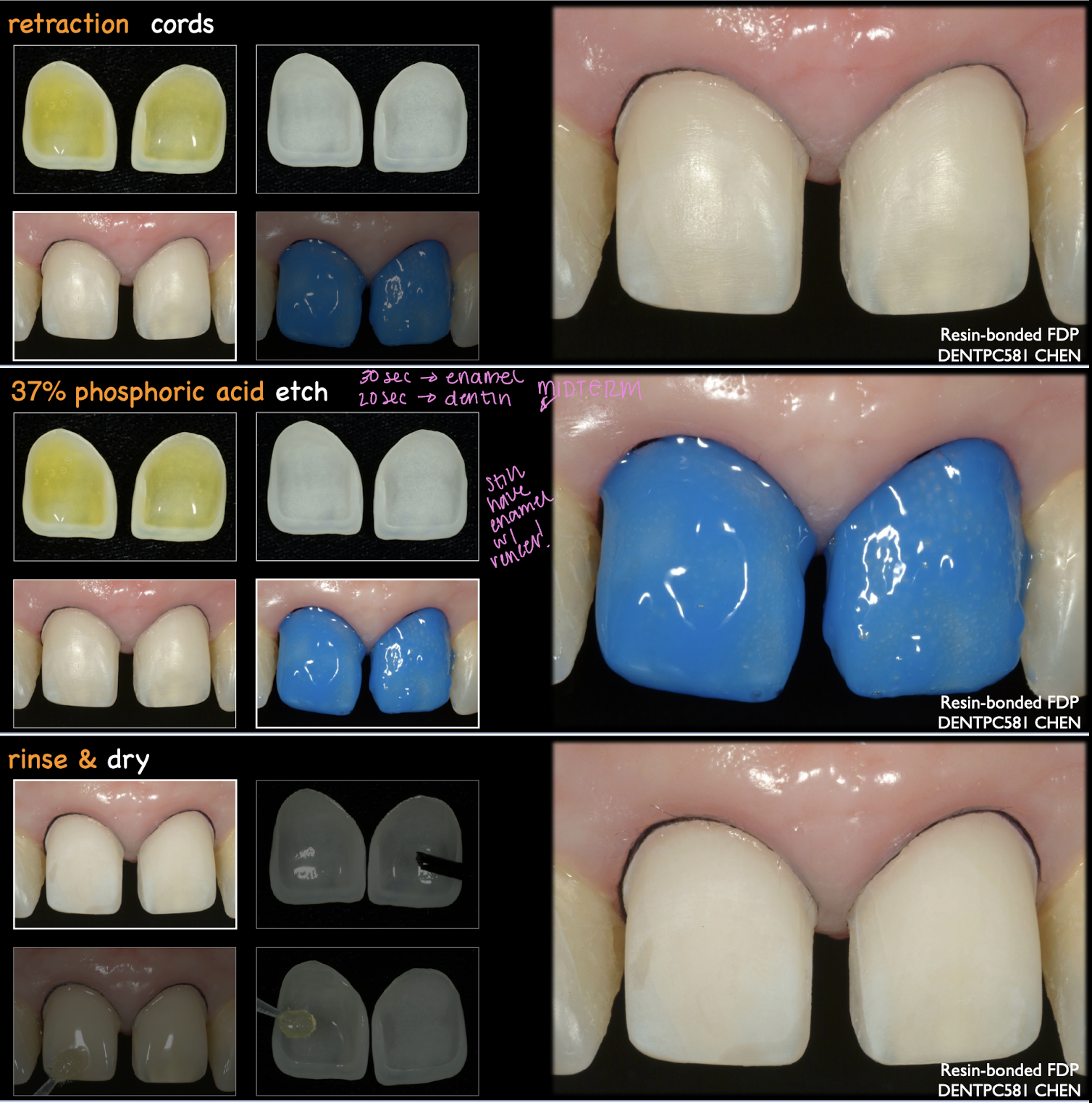 <ol><li><p>retraction cords → 1 is enough</p></li><li><p>pumic powder to clean tooth surface</p></li><li><p>37% phosphoric acid etch → rinse and dry</p><ol><li><p>enamel: <strong>30 sec</strong> → most likely this since veneer prep is mostly enamel</p></li><li><p>dentin: 15/20 sec</p></li></ol></li><li><p>apply bond → air thin → DONT light cure</p></li></ol><p></p>