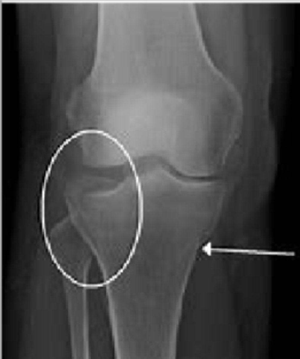 <p>Depression of bone at joint space</p>