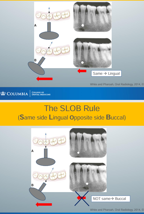 <p>-SLOB: Same side Lingual Opposite side Buccal</p><p>-if the object shifts in the same position as how you have shifted the aiming cylinder, then the object is lingual to a reference point</p><p>-if the object shifts in the opposite position as you have shifted the aiming cylinder, then the object is buccal to a reference point</p>