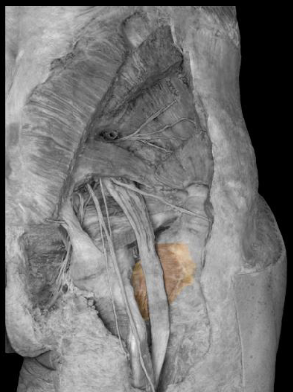 <p>insertion of quadratus femoris</p>