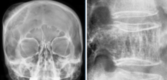 <p>What is this?</p><p>- > 40 yo, Feale</p><p>- No pain</p><p>- Spine & Skull</p>