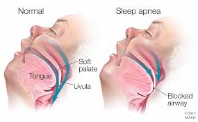 <p>A sleep disorder in which breathing repeatedly stops and starts during sleep.</p>