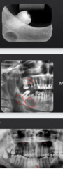 <p>How are these lesions described in terms of number?</p>