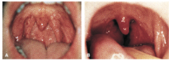 <p>inflammation of the pharynx</p>
