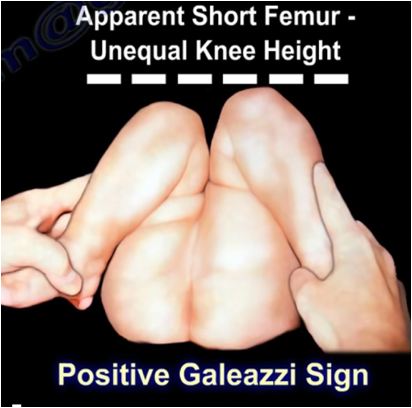 <p>A clinical test for hip dislocation where, with the infant lying supine and knees flexed, one knee appears lower than the other, indicating possible developmental dysplasia of the hip (DDH)</p>