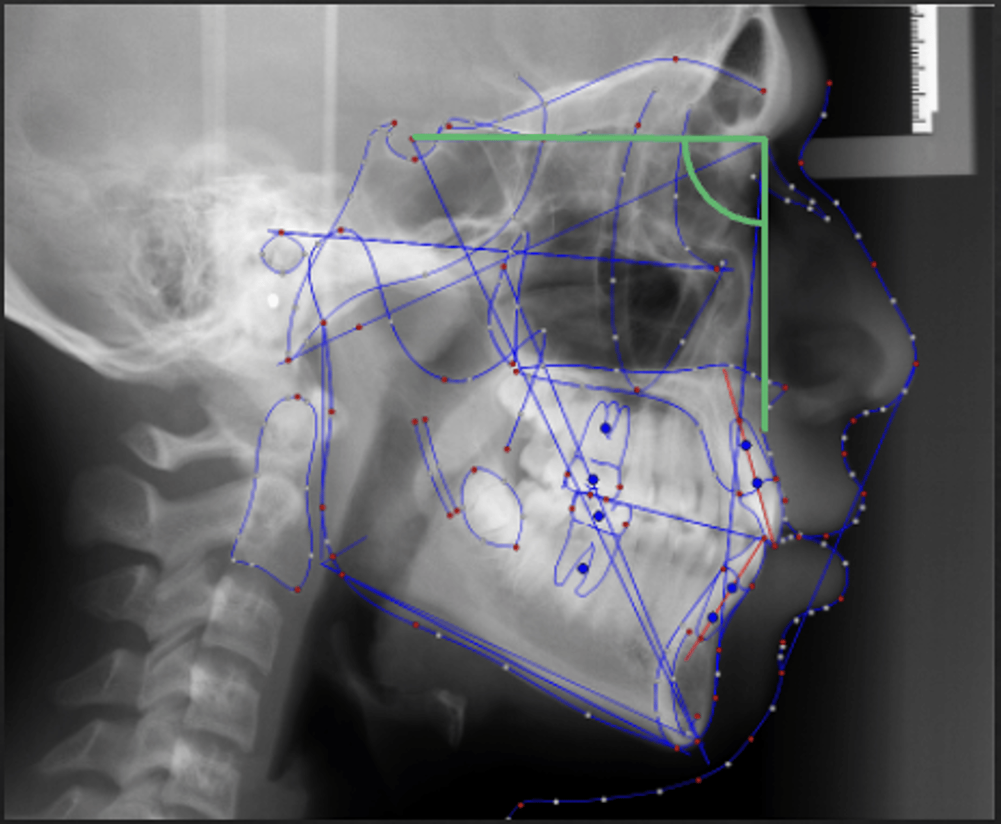 <p>What skeletal measurement:</p><p>- Sella-Nasion vs Nasion-A Point</p><p>- AP relationship between the cranial base and the maxilla</p><p>- Tells you about the AP position of the maxilla</p>