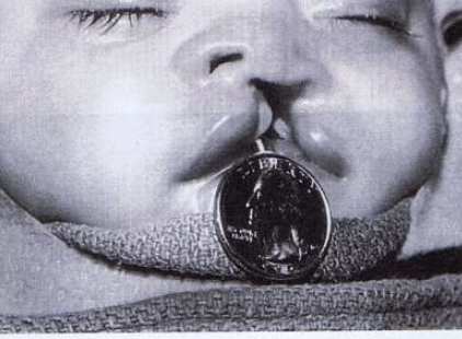 <p>Unilateral cleft of lip and palate </p>