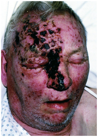 <p>Causative Agent: Activation of shingles along the ophthalmic division of the trigeminal nerve<br>Symptoms/Signs: Vesicular lesions on the forehead, eyelids, nose, and possibly even the eye itself; corneal inflammation, eye pain, and sensitivity.</p>