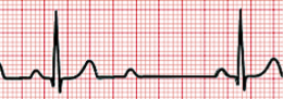 <p>dropped beats, P waves not followed by QRS</p>