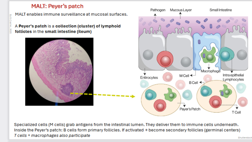 <p>MALT enables <strong>immune surveillance </strong>at mucosal surfaces.</p><p></p><p>A <strong>Peyer’s patch</strong> is a <strong>collection </strong>(cluster) of <strong>lymphoid follicles </strong>in the <strong>small intestine </strong>(ileum)</p><p></p><p><strong>Specialized cells (M cells) grab antigens from the intestinal lumen. They deliver them to immune cells underneath.</strong></p><p></p><p>Inside the <strong>Peyer’s patch</strong>: B cells form primary follicles. If activated → become secondary follicles (germinal centers)</p><p></p><p>T cells + macrophages also participate</p>