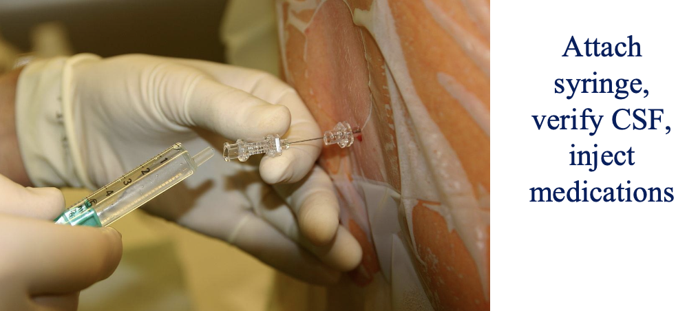 <p>stabilize the needle hub with the non-dominant hand while attaching the syringe with the dominant hand, barbotage (aspirate a small amount of CSF) to verify placement, inject medications, re-aspirate and re-inject a small amount of CSF to confirm stability, and remove the needles and syringe together as a unit in one motion</p>
