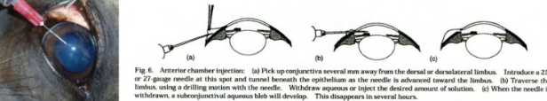<p>- Bulbar conjunctiva is cleaned with dilute betadine</p><p>- Site of entry is dorsal or dorsolateral at limbus with 27 to 30 G needle with syrnged attached</p><p>- Needle is flattened out and direct across the anterior chamber in front of the iris but behind the cornea so the tip of the needle is visible in the anterior chamber prior to aspirating or injecting</p>