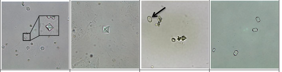 <p>calcium oxalate crystal</p>