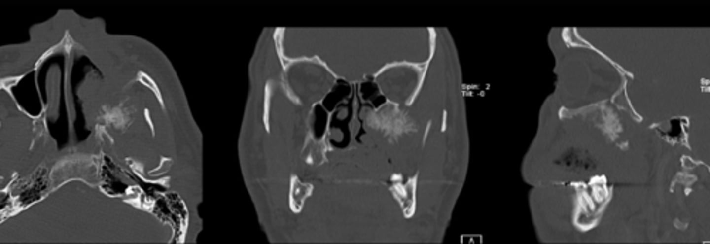 <p>Osteosarcoma</p>