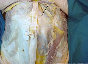 <p>what artery is being indicated to in the image</p>