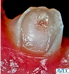 <p>What is this? Where do you most commonly see it? How do you treat?</p>