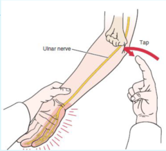 <p>Tap ulnar nerve in olecranon groove; identifies ulnar nerve dysfunction/regeneration.</p>