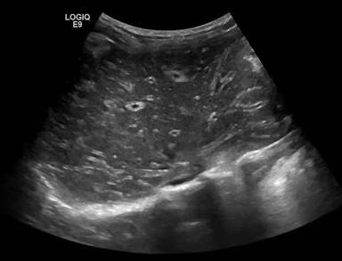 <p>“starry sky” , hepatomegaly, splenomegaly, thick gb walls </p>