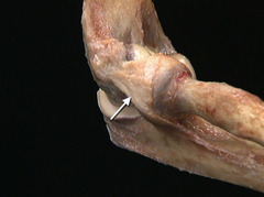 <p>In this lateral view of the right elbow, identify the structure indicated by the arrow.</p>