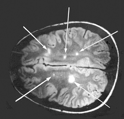 <p><strong><u>McDonald Criteria</u></strong>, which require evidence of:</p><p>1. <strong>Dissemination in space (DIS)</strong></p><ul><li><p>Lesions in <strong><mark data-color="red" style="background-color: red; color: inherit;">different CNS regions</mark></strong></p></li><li><p><strong>“Two separate attacks”</strong></p></li><li><p>Demonstrated via MRI (90% positive)</p></li></ul><p>2. <strong>Dissemination in time (DIT)</strong></p><ul><li><p>Evidence that lesions occurred at <strong><mark data-color="red" style="background-color: red; color: inherit;">different points in time</mark></strong></p></li><li><p><strong>“Two separate lesions”</strong></p></li></ul><p></p>