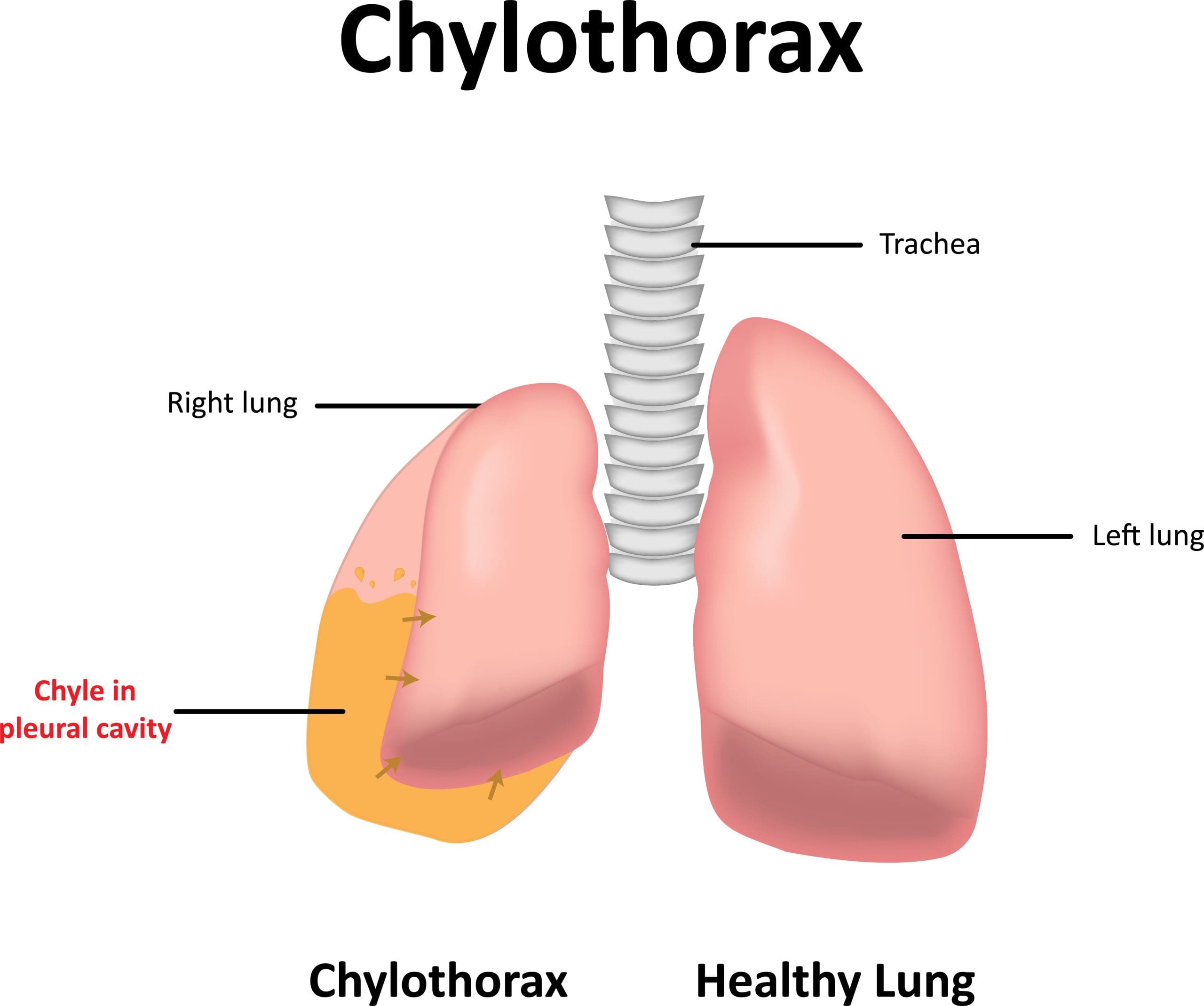 <p>chylothorax</p>