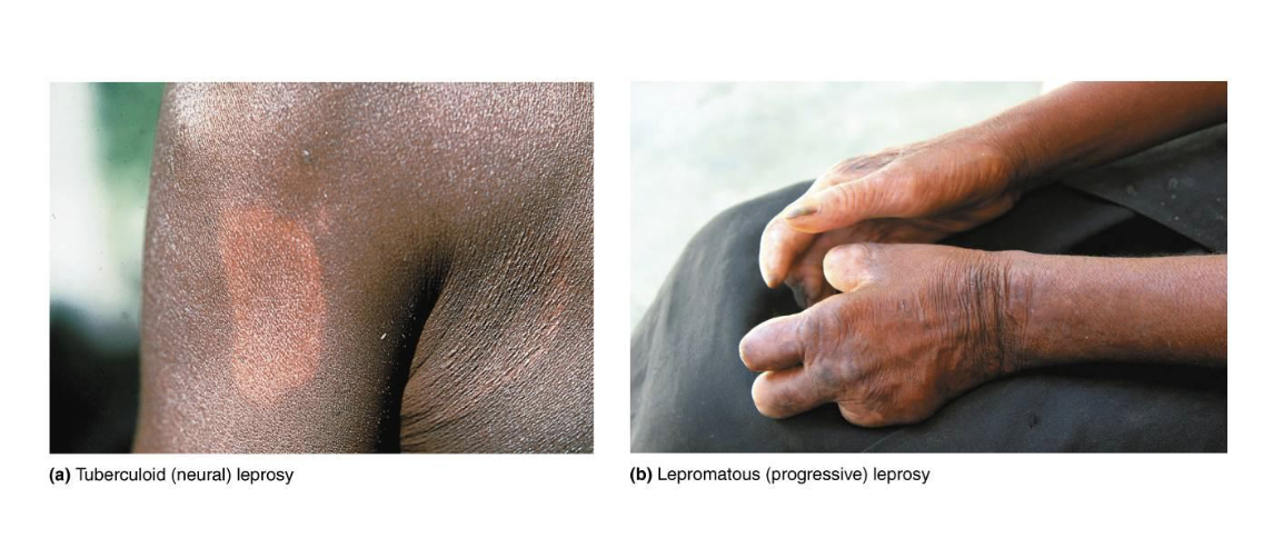 <p>skin biopsy or skin smear, blood test </p>