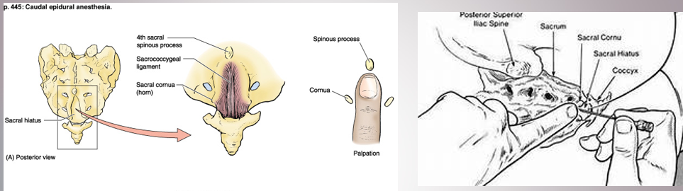 <ul><li><p>acts on S2-Co1 spinal nerves</p></li><li><p>injected into sacral canal via sacral hiatus</p></li><li><p>pudendal nerve block - popular for childbirth - bathes S2-4 spinal nerves so can’t feel birth canal, pelvic floor, but usually doersn’t affect lower limbs so patient can participate</p></li></ul><p></p>