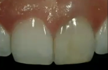 <p>What are some reasons why you’d want to modify the tooth color?</p>