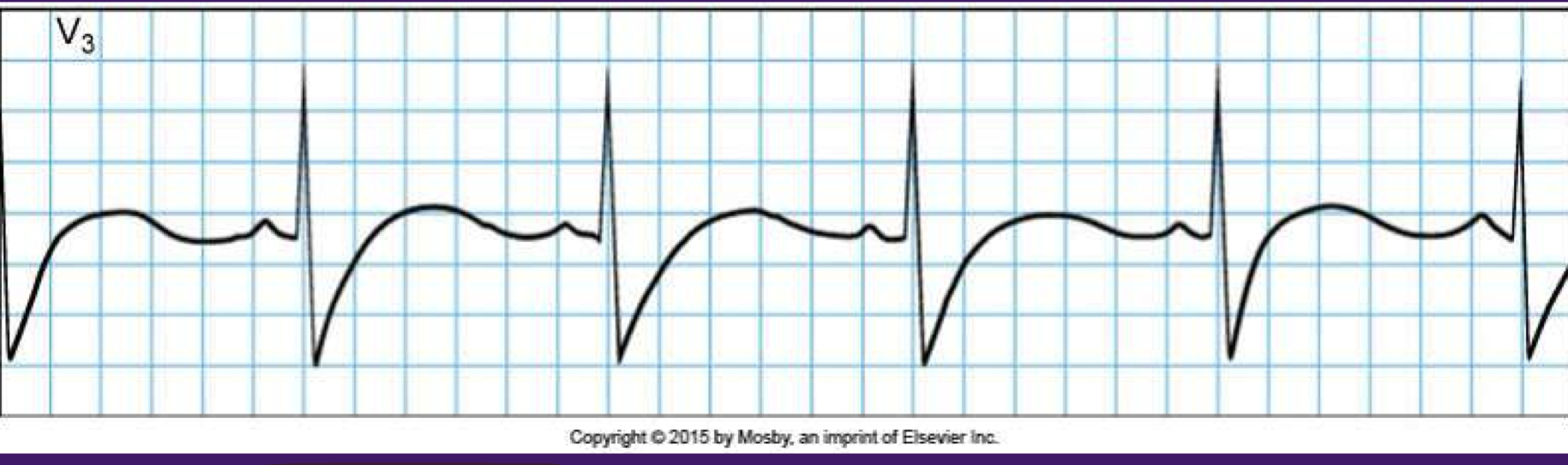 <p>Sinus bradycardia</p>