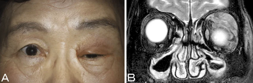 <p>Inflammation of the lacrimal glands, usually caused by bacteria or a virus that initiates the inflammation</p><p>-Dx: clinical, CT orbits if chronic</p><p>-Tx: rest and warm compress if viral </p>