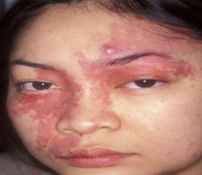 <p>port wine stain complications*</p>