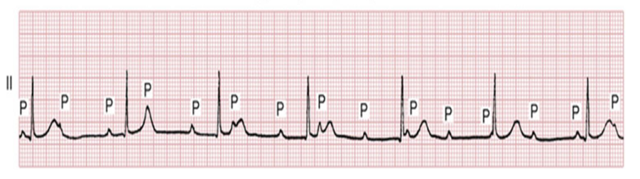 <p>howd yk this was 3rd degree atrioventricular block </p>