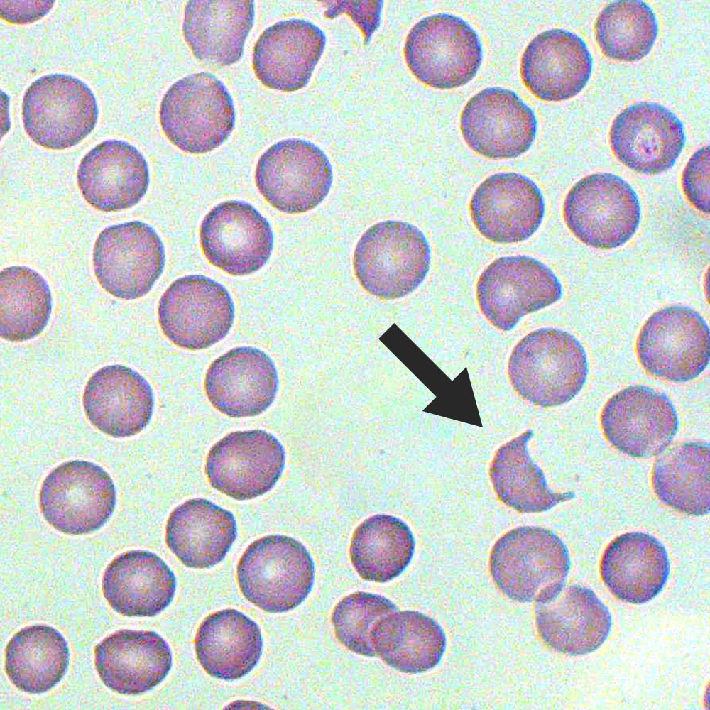 <p>schistocytes are most likely to be found on blood smears of patients suffering from what?</p>