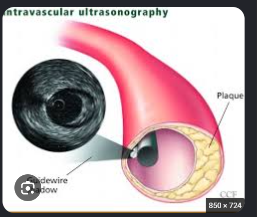 <p>Ultrasound that provides a <strong>cross-sectional view from inside the artery</strong>, using the same basic ultrasound technology used normally.</p><p></p><p>Yes, exactly! IVUS is like putting a tiny camera inside the artery, but instead of using a camera, it uses ultrasound waves to create images.</p><p>How does IVUS work?</p><ol><li><p>A small catheter with an ultrasound transducer at its tip is inserted into the artery.</p></li><li><p>The transducer sends out ultrasound waves from inside the artery.</p></li><li><p>These waves create a cross-sectional view of the artery, allowing doctors to see the lumen and vessel walls.</p></li><li><p>Doctors can identify plaque buildup, stenosis, and vessel size.</p></li></ol><p>Why is IVUS helpful during angioplasty?</p><ul><li><p>Before angioplasty: Helps determine how severe the narrowing is and measure the artery.</p></li><li><p>During stent placement: Helps doctors choose the appropriate stent size.</p></li><li><p>After stent placement: Helps confirm that the stent is properly expanded and positioned.</p></li></ul><p>Remember: IVUS = Ultrasound performed from INSIDE the artery to provide a cross-sectional view of the vessel.</p>