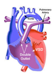 <p>both great arteries connect to the right ventricle</p><p>R-->L shunt</p>
