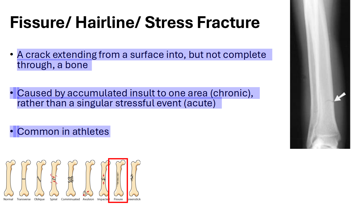 <p>Fissure/ Hairline/ Stress Fracture</p>