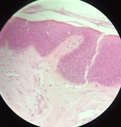 <p>Hairless Skin Stratified Squamous Keratinized - HE (19,25)</p><ul><li><p>built of 3 layers</p></li></ul><ol><li><p>Epidermis - built in Tunica Mucosa<br>a. Epithelium - Stratified squamous keratinized epithelium <br>b. Stratum Basale - Keratin fiber,  cuboidal cells<br>c. Stratum Spinosum - Desmosomes, polygonal cells<br>d. Stratum Granulosum - Keratohyalin, flat squamous epithelium, final layer with alive cells<br>e. stratum Lucidum - keratin<br>f. Stratum corneum - keratin, dead cells, cannot be seen</p><p></p></li><li><p>Dermis - LCT </p></li><li><p>hypodermis - LCT </p></li></ol><ul><li><p>Receptors</p></li></ul><p>BOTH </p><ul><li><p>Extra Cellular Matrix (ECM)</p><ul><li><p>Fibers: Collagen type 1, elastic fibers, ground substance</p></li><li><p>Cells: Fibroblasts, fibrocytes</p></li></ul></li></ul><p></p>