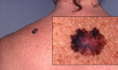 <p>Malignancy of melanocytes</p><p>3rd most common skin cancer (after BCC and SCC)</p><p>Accounts for most skin cancer deaths</p>
