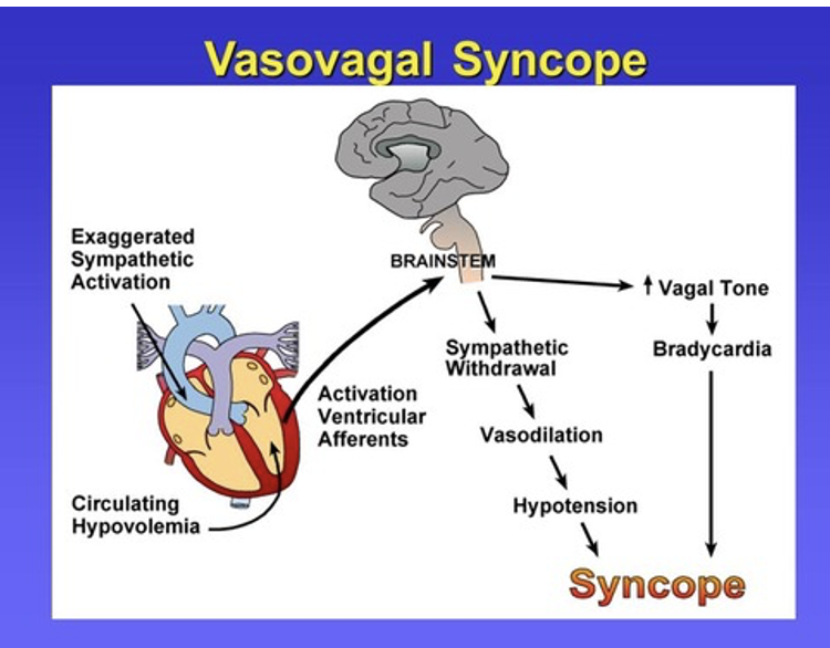 <p>Vasovagal syncope</p>