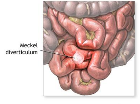 <p>Common birth defect of the ileum caused by the persistence of the yolk sac, resulting in a saclike outpouching of the intestinal wall.</p>