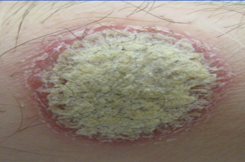 <p>Chronic autoimmune disorder of keratin synthesis characterized by silver-white scaling plaques.</p>