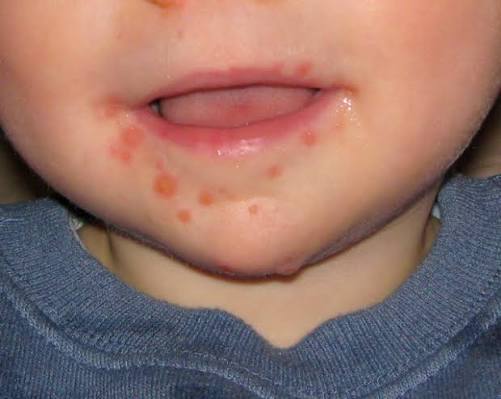 <p>what is <strong>hand, foot, and mouth disease</strong>? *</p>