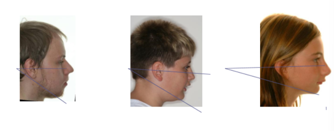 <p>What is the Frankfurt Manidbular planes angle?</p>