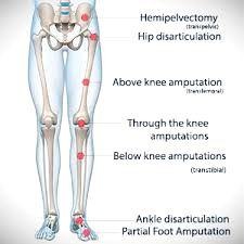<p>Removal of one side of the pelvis.</p>