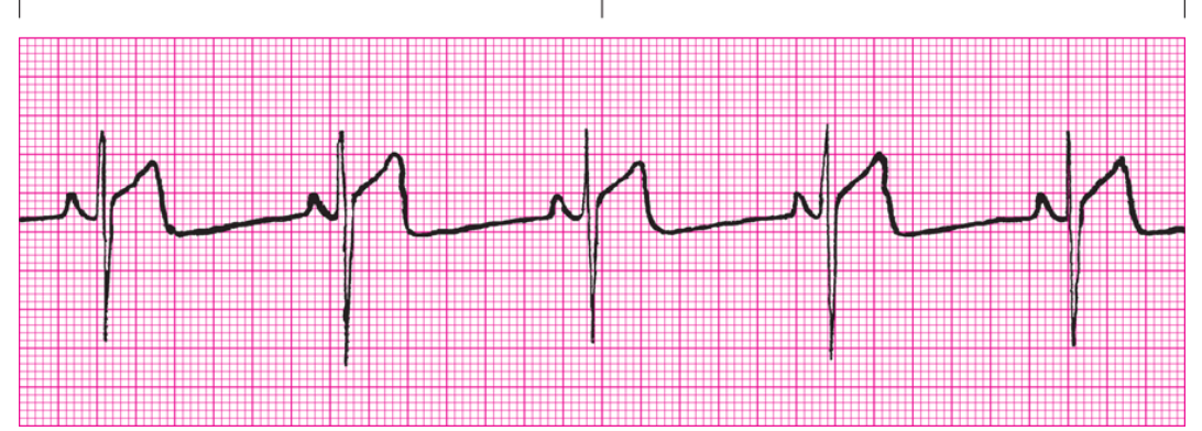 <ol><li><p>Regularity?</p></li><li><p>Rate</p></li><li><p>P Waves</p></li><li><p>PRI</p></li><li><p>QRS</p></li><li><p>Interpretation</p></li></ol><p></p>