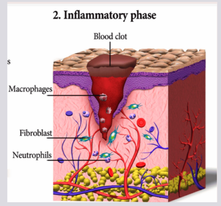<ol><li><p><strong>Neutrophils </strong>arrive first to phagocytose/engulf damaged cells</p></li><li><p>Clear oozing substance due to damaged blood vessels</p></li><li><p><strong>Macrophages</strong> arrive and phagocytose damaged cells, debris, foreign invaders including the neutrophils</p></li></ol><p></p>