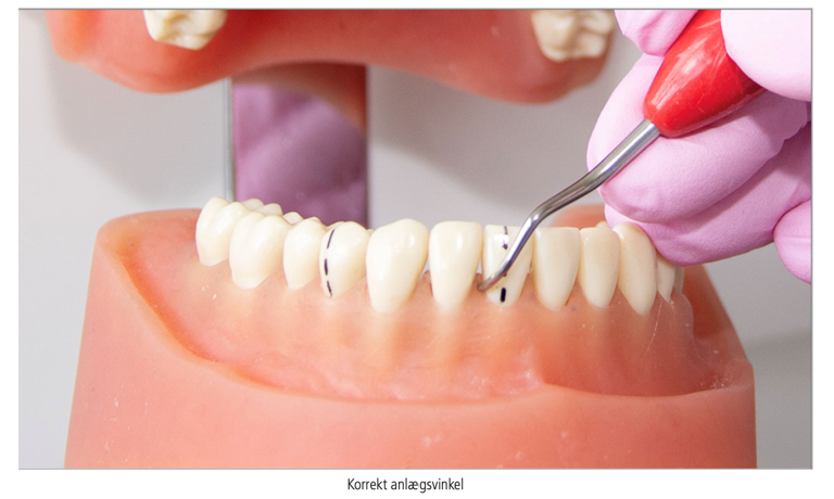 <p><span>Relationen mellem instrumentets faciale flade og tandoverfladen Instrumentets første hals skal være parallel med tandens akse samtidig med at den anden ende af instrumentet peger ud af munden</span></p><p></p><p>Ved depuration er anlægsvinklen af en curette eller scaler ca 45-80 grader. Den ideélle vinkel ved fjernelse af tandsten er 60-80 grader</p>