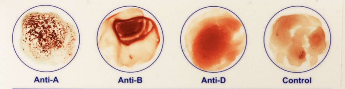 <p><span><strong>Identify the blood type indicated by the test results in the image.</strong></span></p>